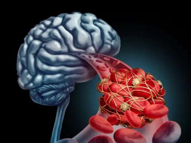 Nhồi máu não đến quá nhanh, nhận biết được 5 triệu chứng bạn sẽ tự cứu sống mình