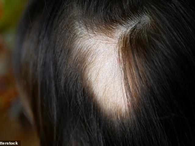 Gần 1/4 bệnh nhân bị... mất tóc sau khi nhiễm COVID-19