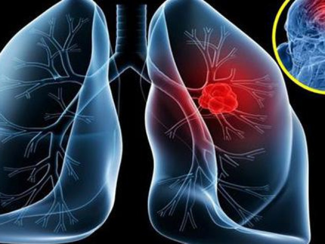 NSƯT Tiến Hợi qua đời vì ung thư phổi: 4 dấu hiệu dễ nhận biết nhất nhưng rất dễ bị bỏ qua