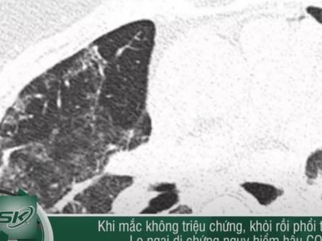 Nguy cơ phổi trắng xóa hậu COVID-19 dù là F0 không triệu chứng