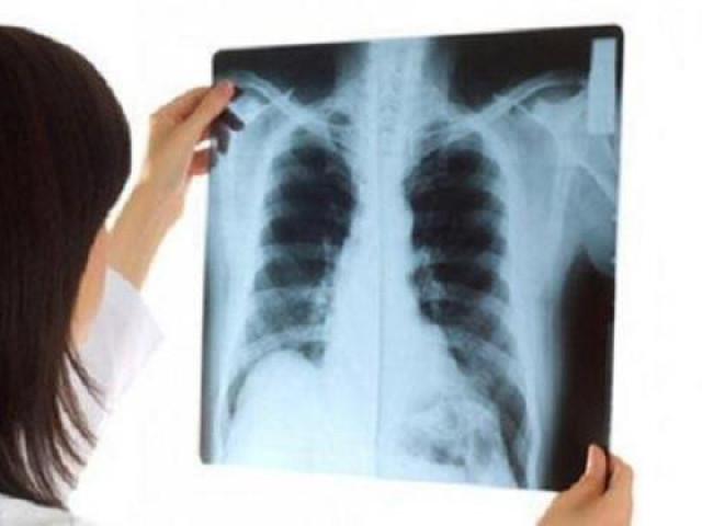 Người phụ nữ ung thư phổi di căn dù chỉ có dấu hiệu khó thở, tức ngực
