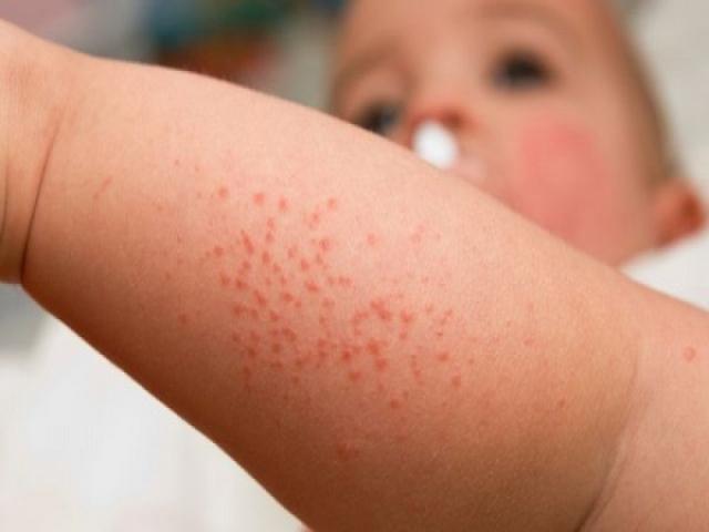 Chuyên gia hướng dẫn cách phân biệt sốt xuất huyết và sốt virus cực đơn giản