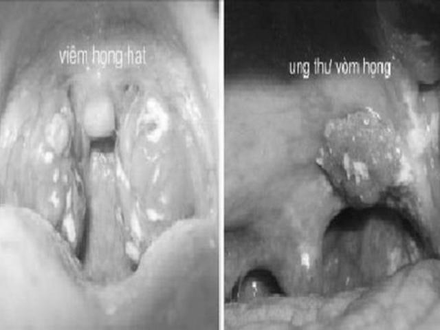 Cách phân biệt ung thư vòm họng và viêm họng