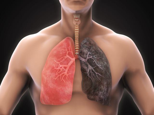 12 dấu hiệu cực sớm phát hiện ung thư phổi, cần đi khám ngay lập tức