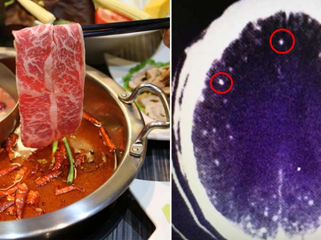 Không nấu chín thịt đúng cách khi ăn lẩu, người đàn ông bị nhiễm ký sinh trùng não