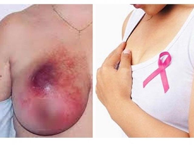 Nhiều phụ nữ trẻ đã mắc ung thư vú, bác sĩ chỉ rõ dấu hiệu nhận biết
