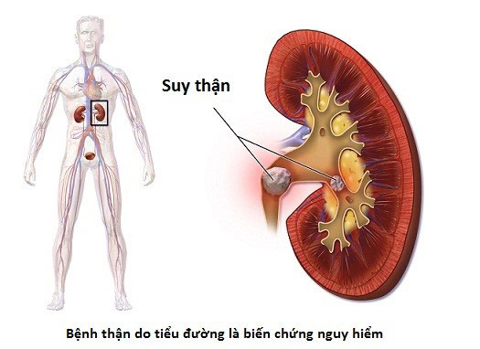 4 quy tắc giúp người tiểu đường cả đời không lo suy thận - 1