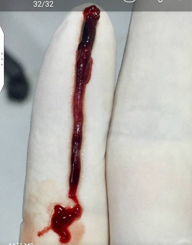 Mổ lấy được cục máu đông gây đột quỵ dài gần 10cm - 1