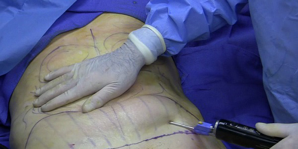 “Đặt lên bàn cân” những phương pháp giảm béo được quan tâm nhiều nhất - 1