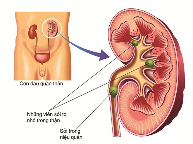 Điều trị sỏi mật, sỏi thận dưới góc nhìn Tây y và Đông y - 1