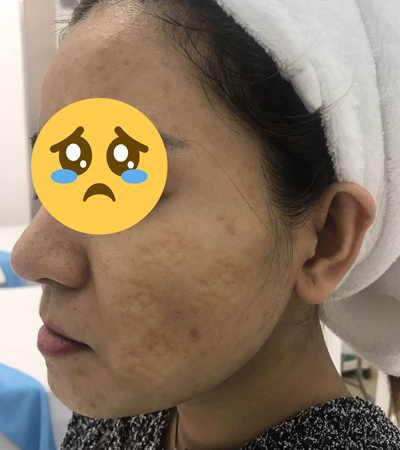 10 năm tìm cách trị sẹo rỗ và cái kết ngọt cùng Evie Clinic & Spa - 1