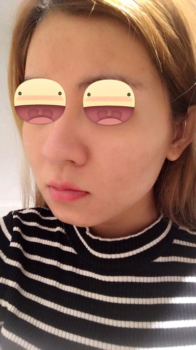 10 năm tìm cách trị sẹo rỗ và cái kết ngọt cùng Evie Clinic & Spa - 2