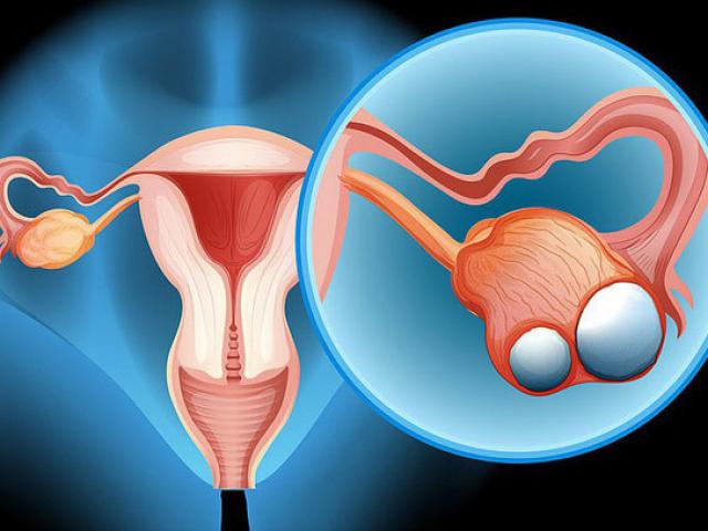 Thuốc tránh thai làm giảm nguy cơ ung thư buồng trứng