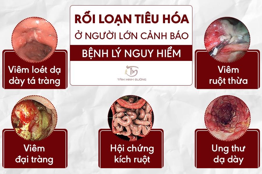 Rối loạn tiêu hóa kéo dài ở người lớn uống thuốc gì? - 2