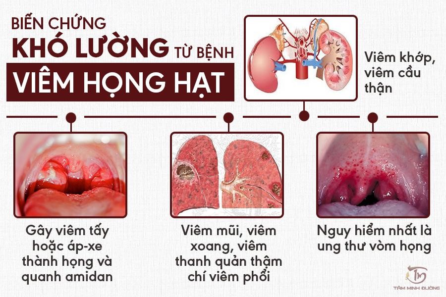 Nguyên nhân, triệu chứng, cách chữa viêm họng hạt hiệu quả vượt trội - 2