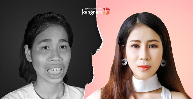 Tổng hợp 5 ca ‘’lột xác’’ ngoại hình gây xôn xao năm 2018 - 1
