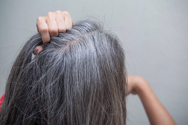 9. Căn bệnh tóc bạc trắng chỉ sau 1 đêm: Nếu tóc đột ngột chuyển sang màu trắng do căng thẳng hoặc tin xấu, bạn có thể bị mắc hội chứng Marie Antoinette. Một số nguyên nhân được đề xuất có thể do rối loạn tự miễn nhắm vào melanin, ảnh hưởng đến sản xuất sắc tố.