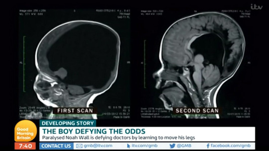 Kỳ diệu cậu bé sinh ra không não vẫn sống khỏe mạnh - 2
