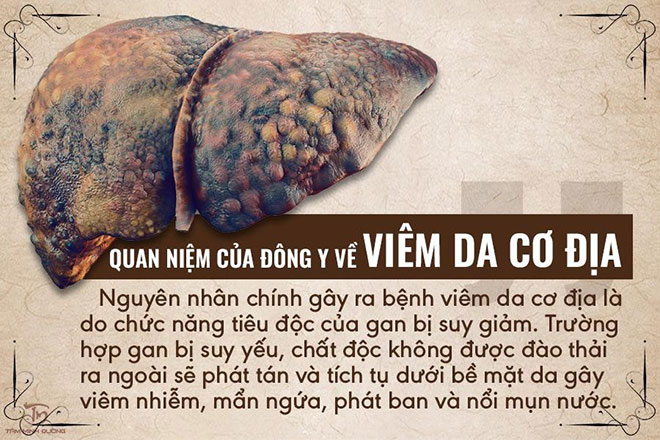 Viêm da cơ địa: Nguyên nhân, triệu chứng và cách chữa trị chuẩn chỉ - 2