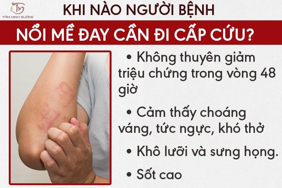 Bệnh nổi mề đay: Nguyên nhân, dấu hiệu và cách điều trị đánh bay ngứa - 2