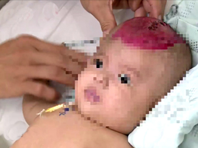 Điện thoại rơi trúng đầu, bé gái hơn 2 tháng tuổi bị chấn thương sọ não - 1