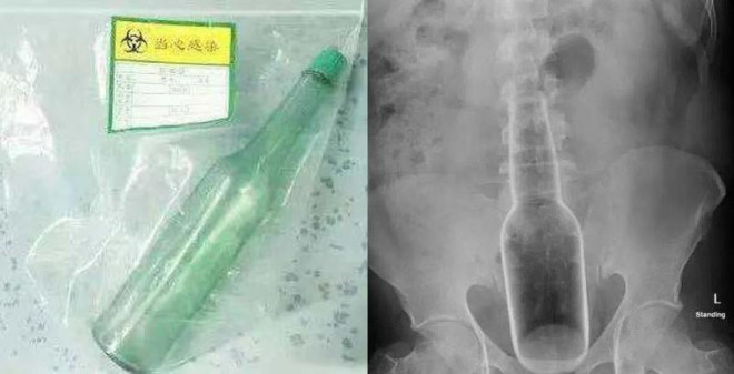 Cái chai sau khi được lấy ra khỏi bụng nạn nhân và hình chụp X-quang trước đó. Ảnh: Shanghaiist