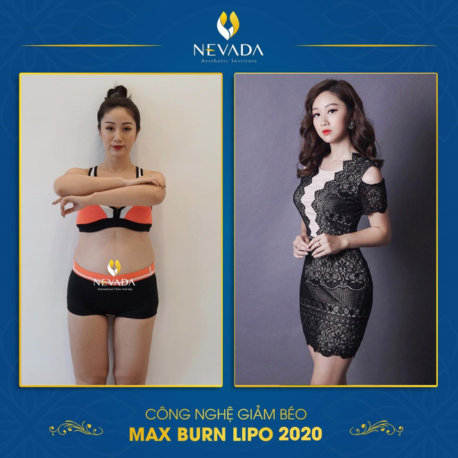 Phương Thảo trước và sau khi sử dụng 1 liệu trình Max Burn Lipo