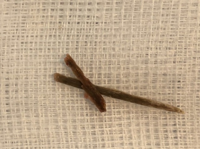 Dị vật dài 5 cm được lấy ra từ đại tràng bệnh nhân.