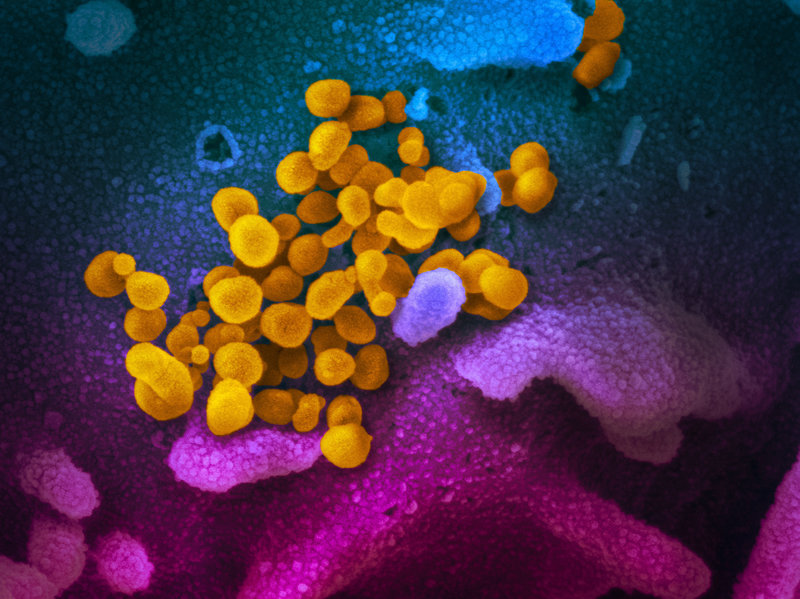 Virus Corona màu vàng nằm bên trên các tế bào màu tím và xanh.