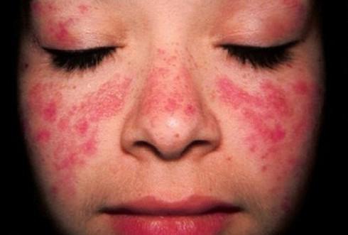 Các ban đỏ hình cánh bướm ở hai bên má là biểu hiện thường thấy của bệnh lupus ban đỏ hệ thống