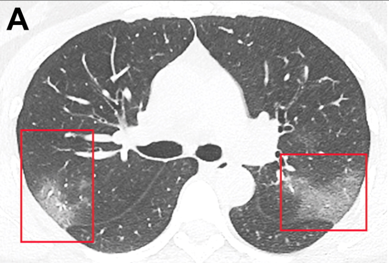 Phần màu trắng (khoanh đó) cho thấy tổn thương của bệnh nhân nhiễm virus Corona.