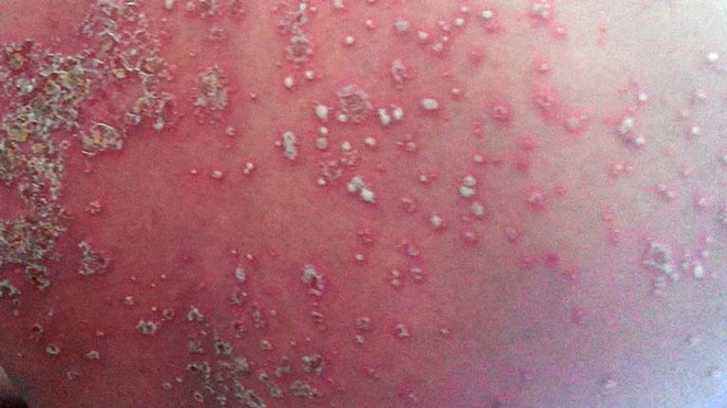 Bệnh vảy nến thể mủ liên quan đến sự suy yếu, rối loạn của hệ miễn dịch