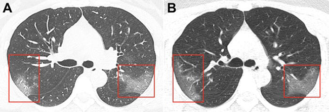 Hình ảnh phổi của bệnh nhân nhiễm Covid-19 bị virus Corona tàn phá - 1