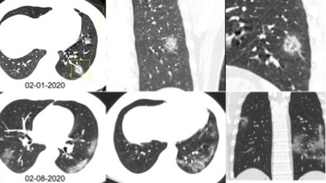 Hình ảnh phổi của bệnh nhân nhiễm Covid-19 bị virus Corona tàn phá - 7