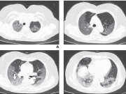 Sức khỏe đời sống - Hình ảnh phổi của bệnh nhân nhiễm Covid-19 bị virus Corona tàn phá