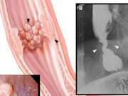 Sức khỏe đời sống - Nuốt nghẹn dấu hiệu cảnh báo ung thư nguy hiểm