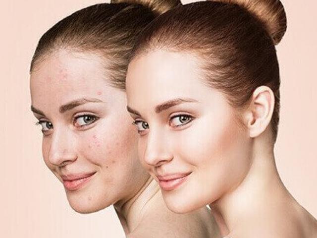 Nếu có làn da khô, tuyệt đối tránh 5 thành phần dễ có trong sản phẩm làm đẹp