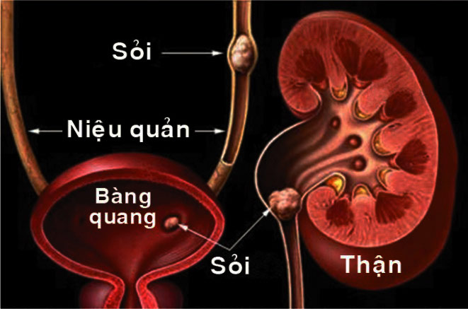 Thừa canxi hoặc bổ sung canxi sai cách có thể gây sỏi thận