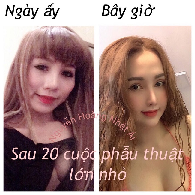 Cô cũng thừa nhận, trước khi phẫu thuật thẩm mỹ, bản thân trông già hơn tuổi vì gương mặt góc cạnh, gò má cao, hốc má trũng sâu, vòng và vòng 3 rất khiêm tốn.