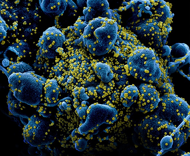 Virus (màu vàng) xâm nhập, nhân bản đến một mức độ sẽ khiến tế bào người chết rụng (màu xanh), từ đó giải phóng ra ngoài vô số virus.