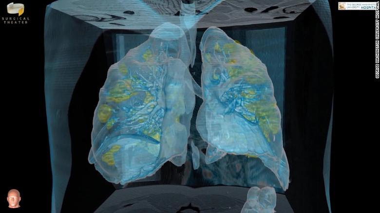 Vết viêm nhiễm rải rác khắp phổi người bệnh.