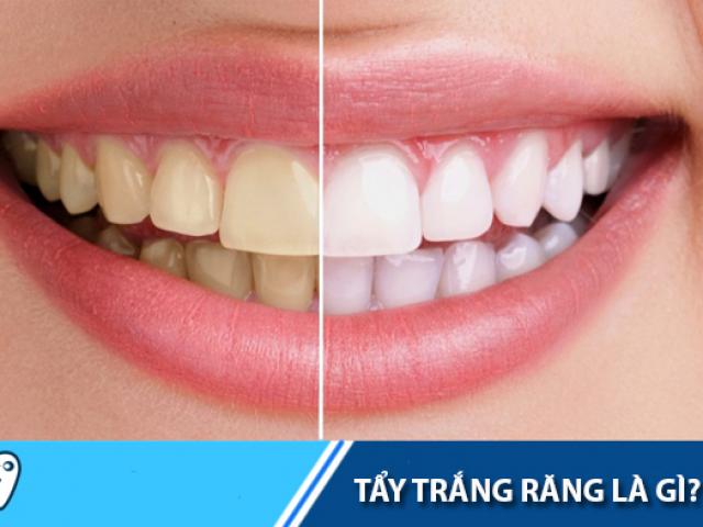 Tẩy trắng răng có đau và gây hại ảnh hưởng  tới sức khỏe không?