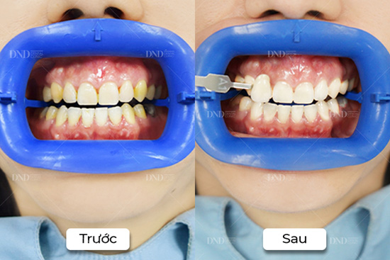 Philips Zoom là phương pháp tẩy trắng răng an toàn, được ưa chuộng tại Mỹ