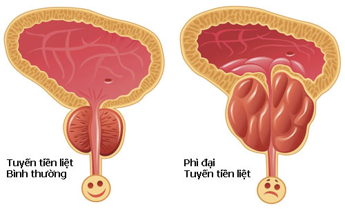 Quý ông đi tiểu nhiều coi chừng mắc căn bệnh siêu khó chịu này - 2