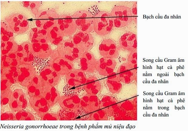 Quan hệ tình dục thiếu an toàn làm tăng bệnh&nbsp;lây truyền