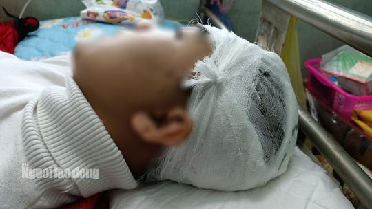 Em Phan Thanh L. bị đánh vỡ sọ não đang được điều trị tại Bệnh viện Đa khoa tỉnh Thanh Hóa