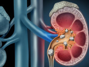 Sức khỏe đời sống - 5 dấu hiệu cho thấy hai quả thận quý giá đang chứa đầy sỏi