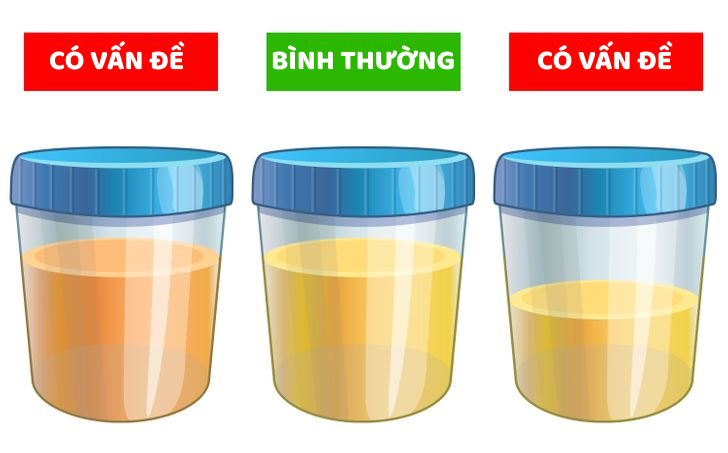 5 dấu hiệu cho thấy hai quả thận quý giá đang chứa đầy sỏi - 2