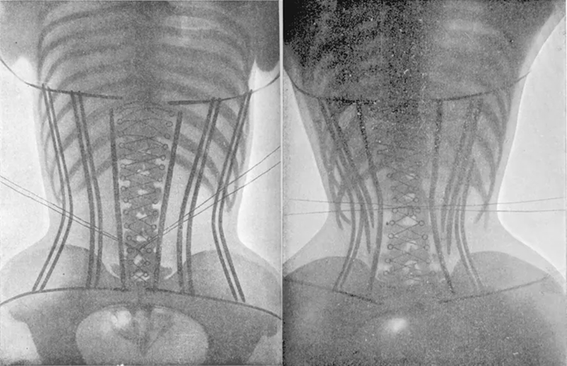 Nhưng corset gây ra không ít đau đớn cho người mặc và ảnh hưởng nghiêm trọng tới sức khỏe.