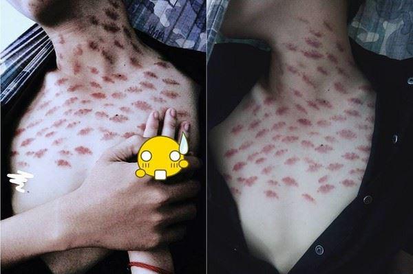 Hickey cũng là 1 hình thức đánh dấu nhiều bạn trẻ thường làm, nhưng hickey cũng rất nguy hiểm nên hãy cẩn thận khi thực hiện nó nhé!